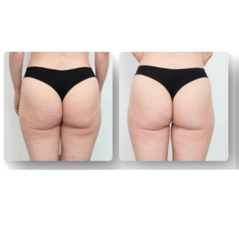 Luxe Anticellulite Massager voor Huidverjonging
