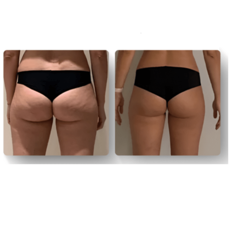 Luxe Anticellulite Massager voor Huidverjonging