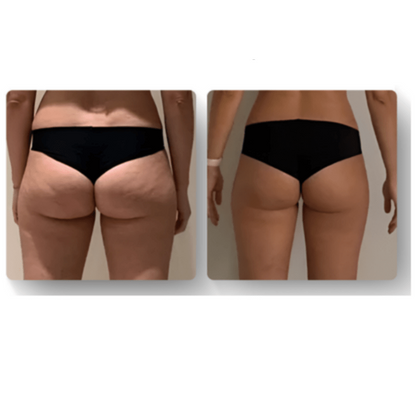 Luxe Anticellulite Massager voor Huidverjonging