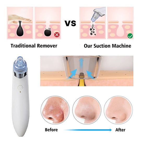 Blackhead Verwijderapparaat 4-in-1 Oplaadbaar voor Helder Huid