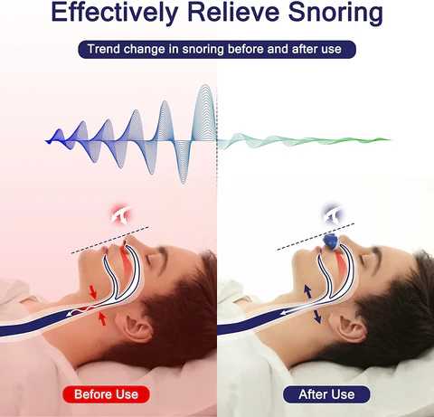 CPAP Apparaat Snurken Stoppen Anti Snurk Therapie