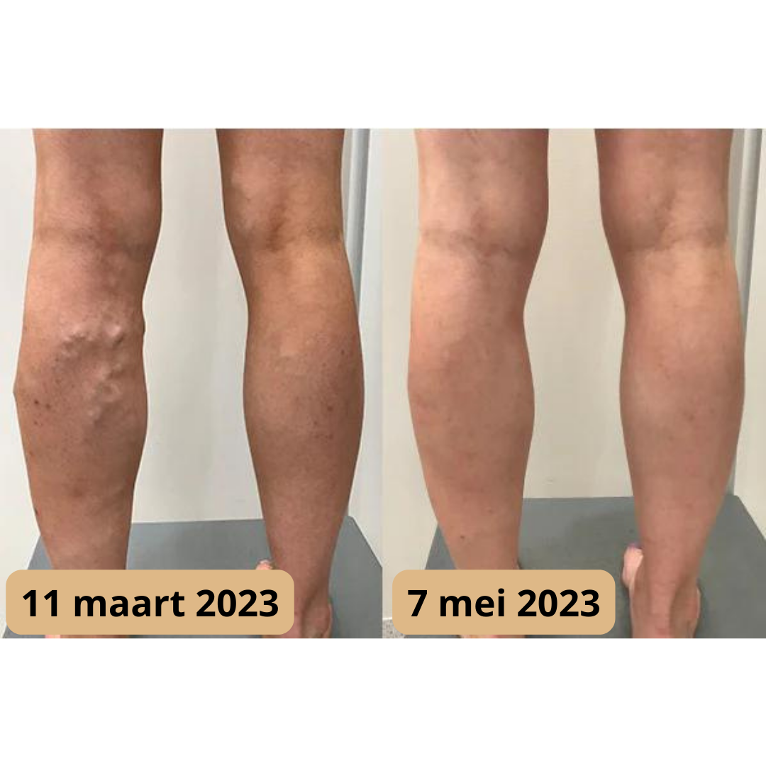 Lymfomat voor Verbeterde Doorbloeding en Acupunctuur Therapie
