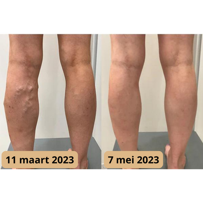 Lymfomat voor Verbeterde Doorbloeding en Acupunctuur Therapie