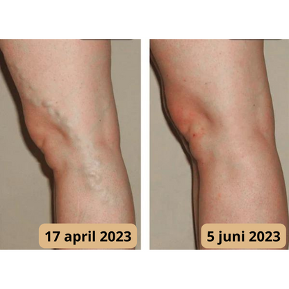 Lymfomat voor Verbeterde Doorbloeding en Acupunctuur Therapie