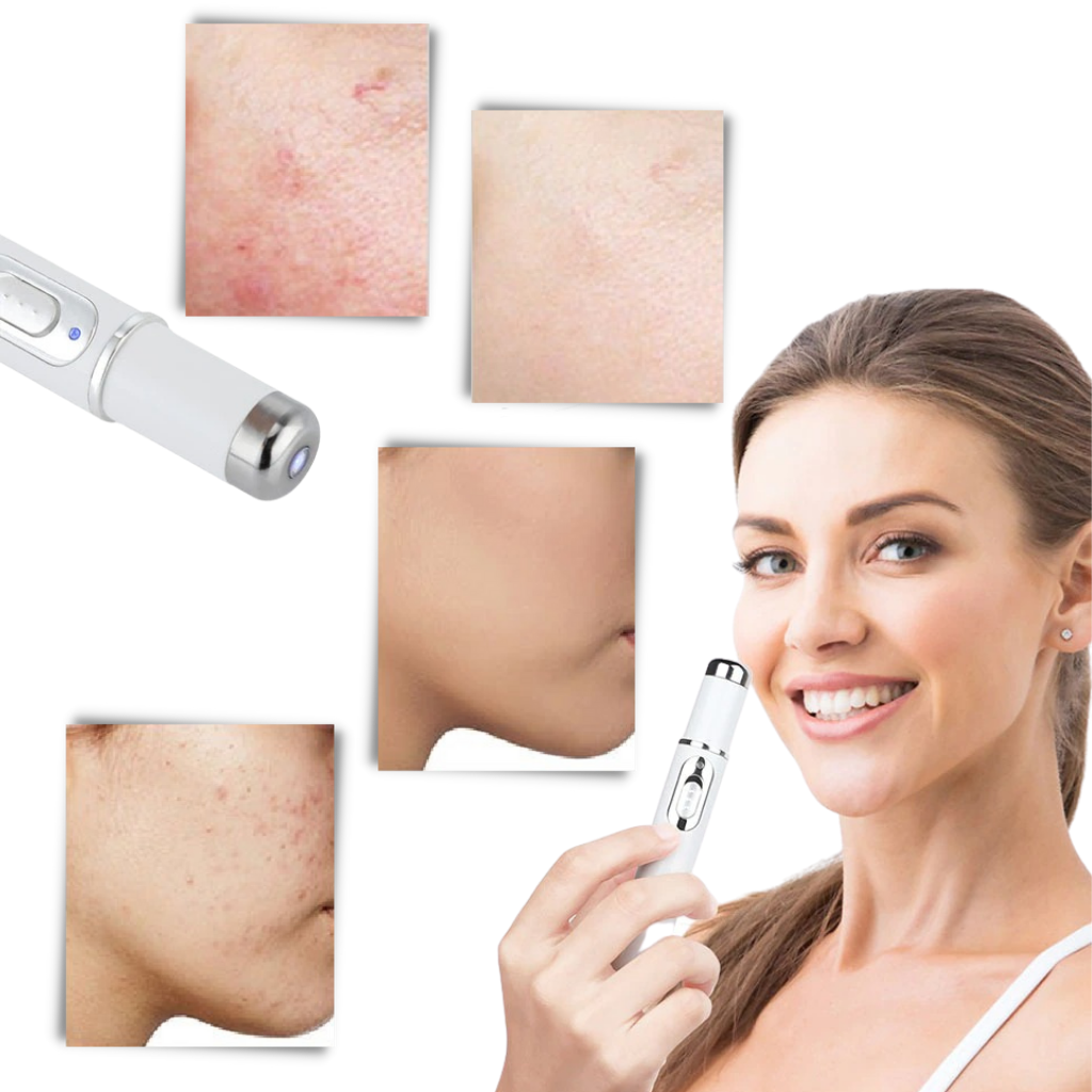 Blauwe Licht Huidtherapie Pen Acne Behandeling