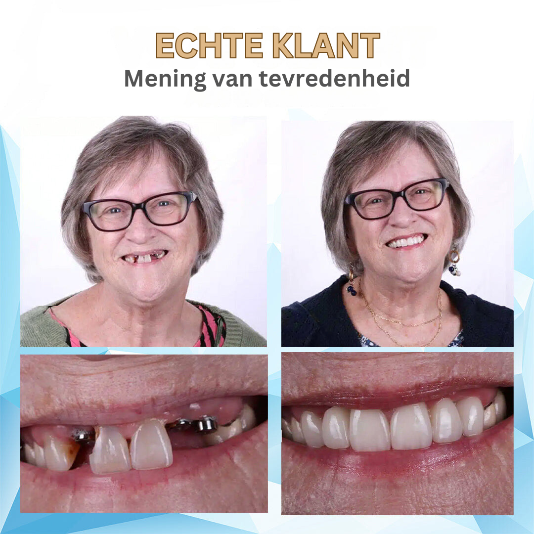 Betaalbare Kunstgebitten voor Volledig Comfort