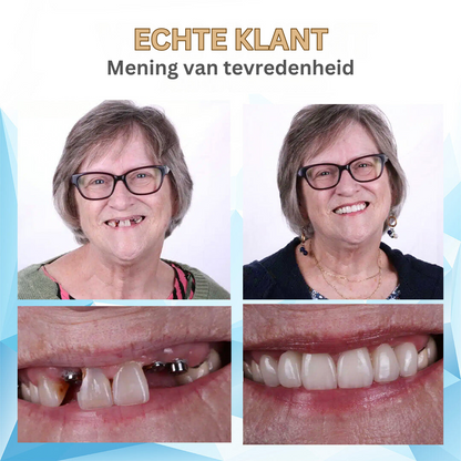Betaalbare Kunstgebitten voor Volledig Comfort