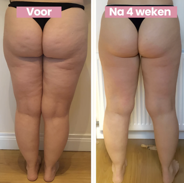 Anti-Cellulite Behandeling voor Huidverstrakking en Gladde Huid