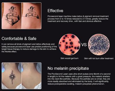 Laser tatoeageverwijdering thuis 4