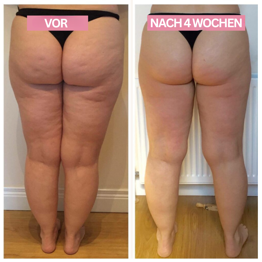 Cupping Apparaat Anti Celulite Verwijderen Thuis