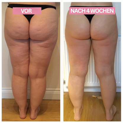 Cupping Apparaat Anti Celulite Verwijderen Thuis