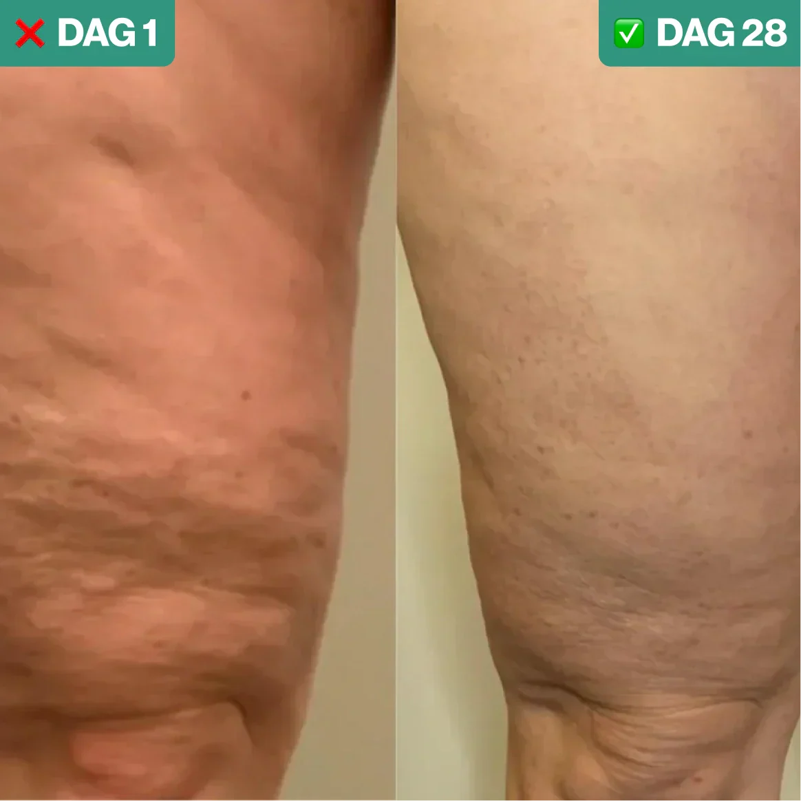 Anti-Cellulite Behandeling voor Huidverstrakking en Gladde Huid
