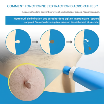 Cryotherapie Kit voor Huidwratten Verwijderen Eenvoudig Thuis