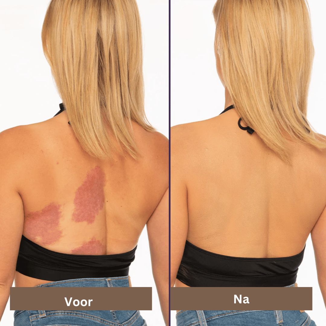 Littekens en Vlekken Camouflage Makeup Crème