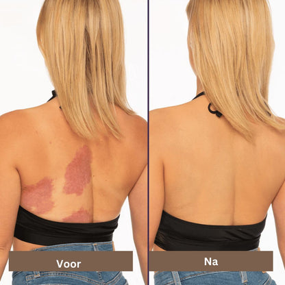 Littekens en Vlekken Camouflage Makeup Crème